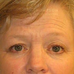 Upper Eyelid (Blepharoplasty) | Browlift – 787