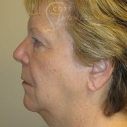 Facelift | Fat Injections | Browlift | Upper & Lower Eyelid Surgery